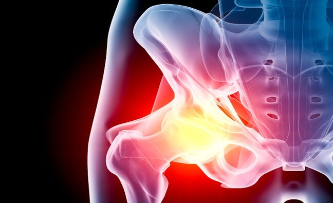 arthrose de l'articulation de la hanche