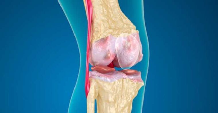 Arthrose de la maladie articulaire du genou, qui provoque la destruction du cartilage dans les articulations