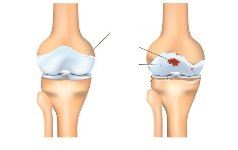 Sain et patient avec des articulations d'arthrose